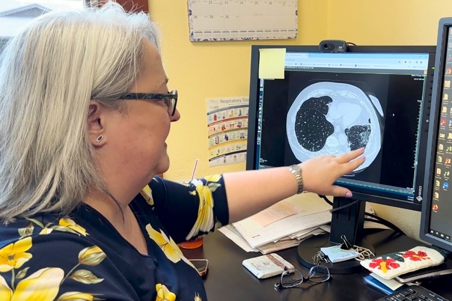 FILE - Dr. Lee Morissette shows an image of lungs damaged by asbestos exposure, April 4, 2024, at the Center for Asbestos Related Disease in Libby, Mont. (AP Photo/Matthew Brown, File)