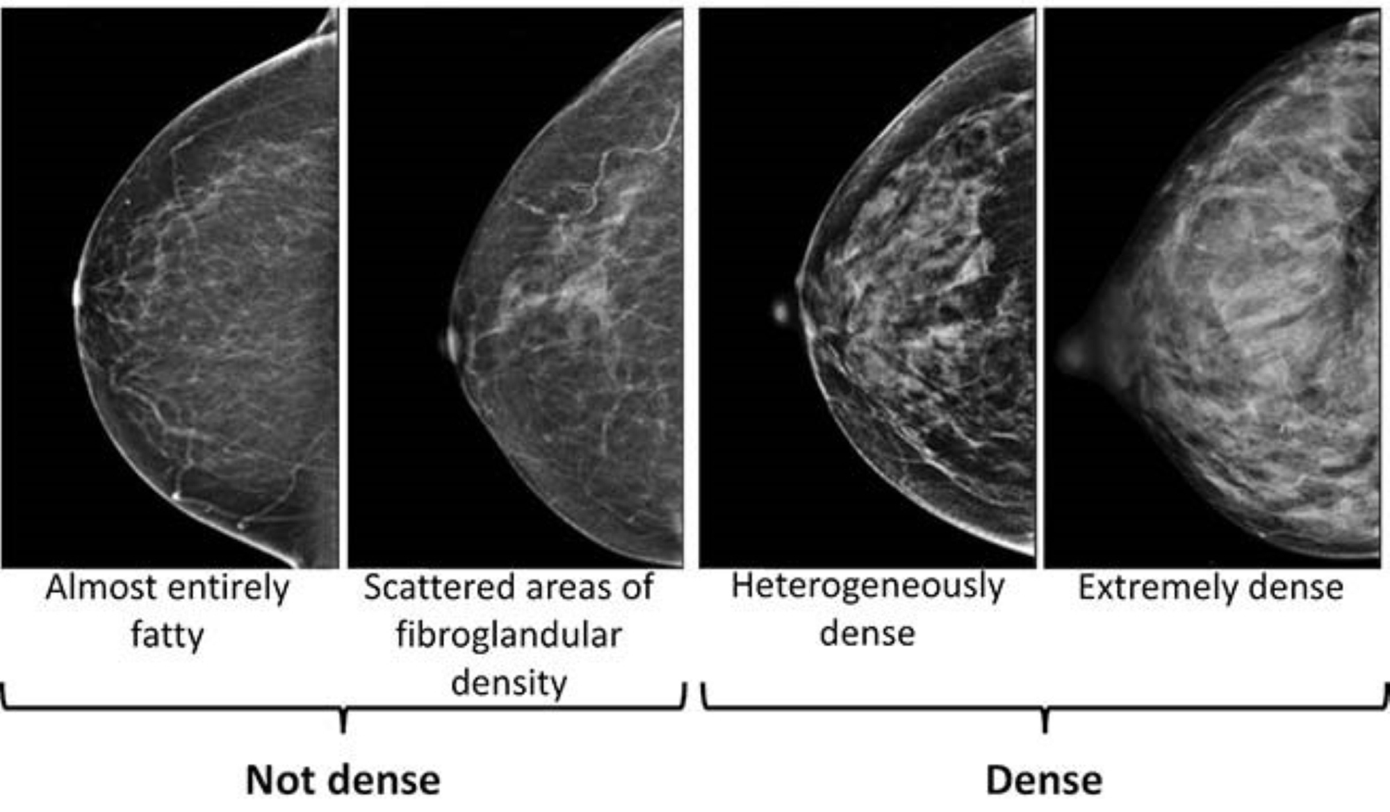 This image provided by the UW/Fred Hutch Cancer Center Breast Imaging in October 2024 shows mammogram scans with dense and not dense tissue. (UW/Fred Hutch Cancer Center Breast Imaging via AP)