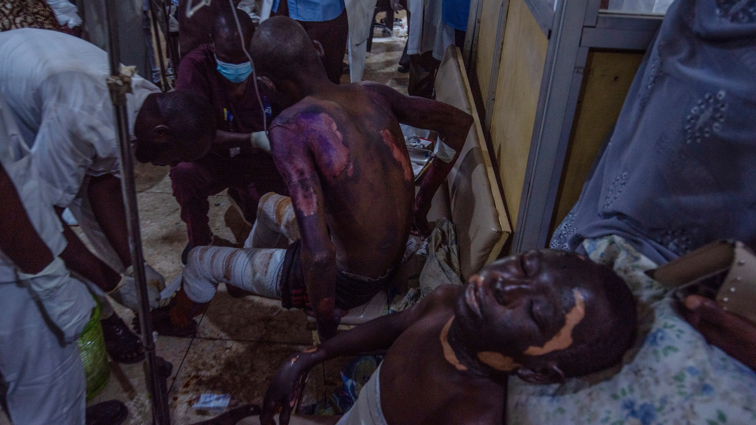 Victims of a tanker explosion from Majiya town receive treatment at the Aminu Kano teaching hospital in Kano Nigeria, Wednesday, Oct. 16, 2024. (AP Photo/Sani Maikatanga)