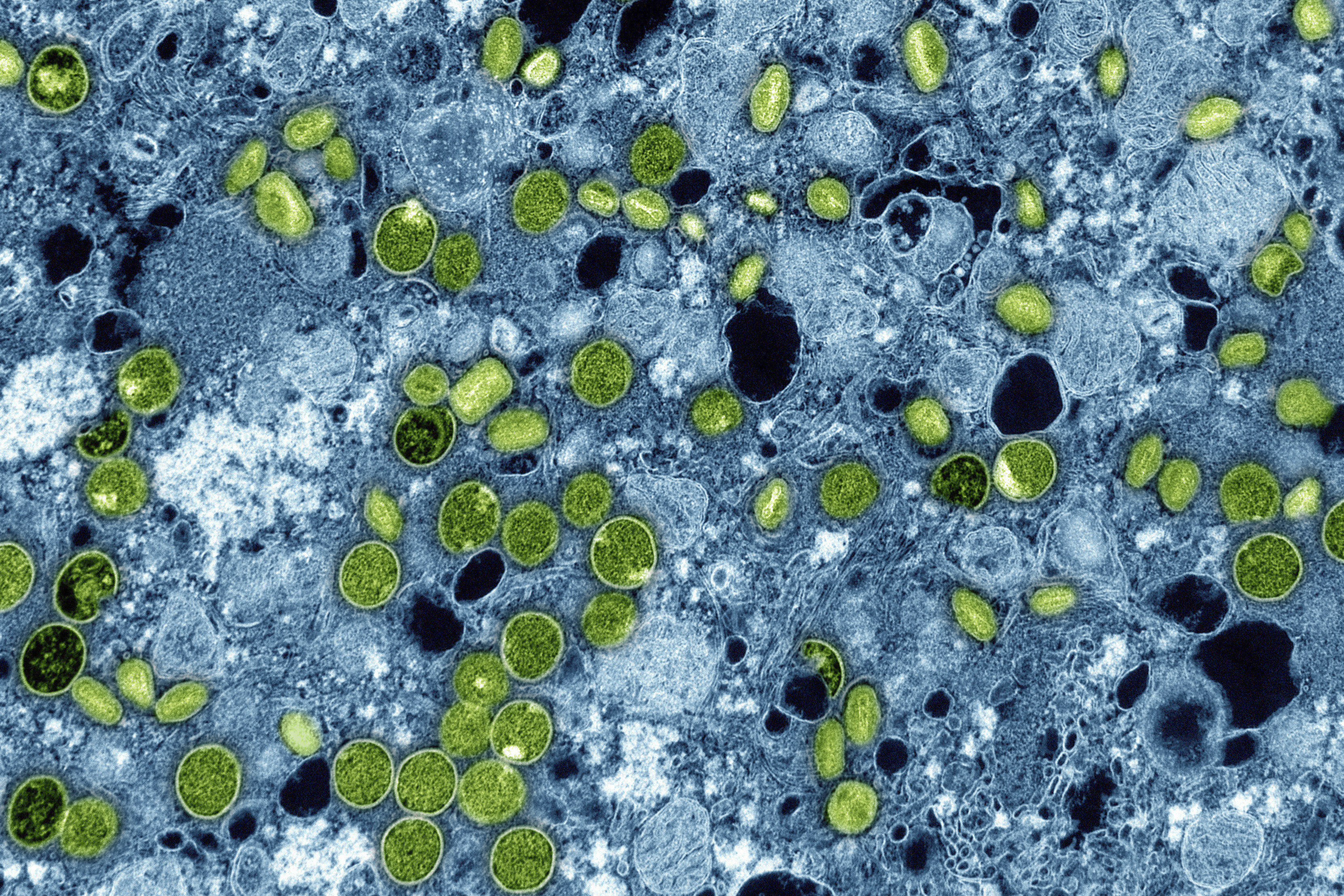 FILE - This colorized electron microscope image provided by the National Institute of Allergy and Infectious Diseases in 2024 shows Mpox virus particles, green, found within infected cultured cells, blue. The virus particles are in various stages of maturity, which accounts for differences in shape. (NIAID via AP, File)