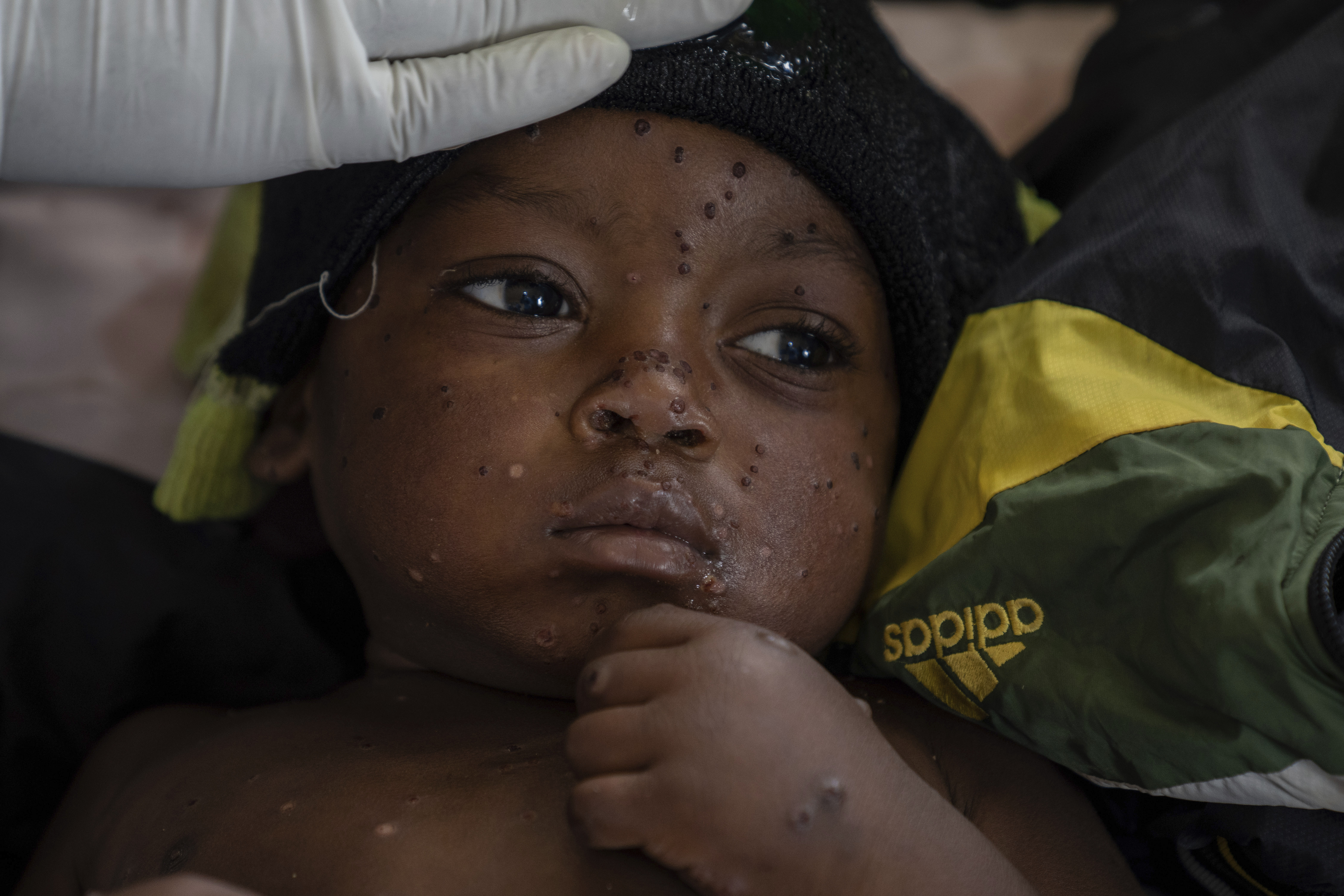 FILE - 2 year old Emile Miango, who has mpox, lies in a hospital, in Kamituga, South Kivu province, Sept. 4, 2024, which is the epicenter of the world's latest outbreak of the disease in eastern Congo. (AP Photo/Moses Sawasawa, file)