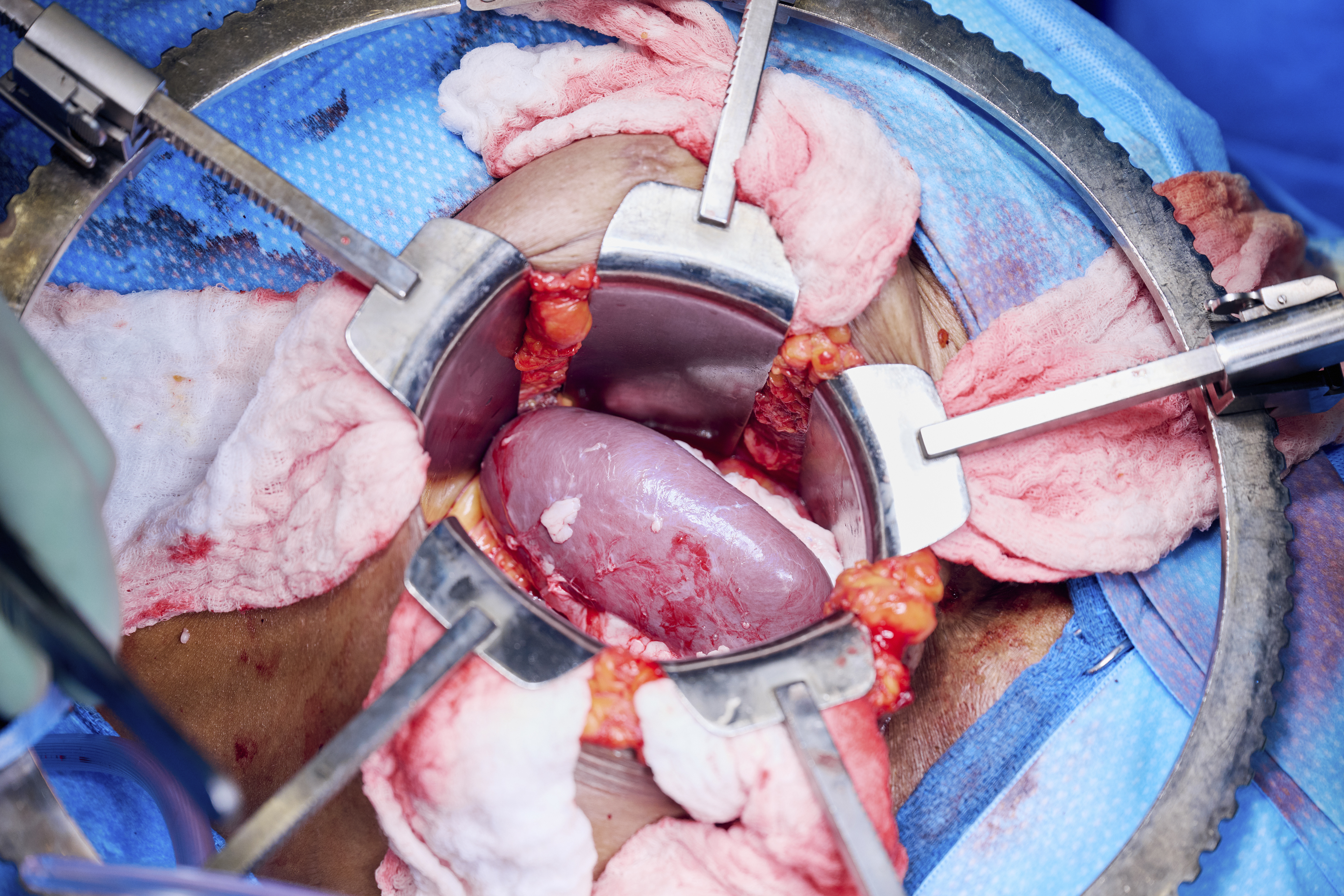 The gene-edited pig kidney moments after blood vessels are reattached and the organ is reperfused with Towana Looney’s blood at NYU Langone Health in New York City on Nov. 25, 2024. (Joe Carrotta/NYU Langone Health via AP)