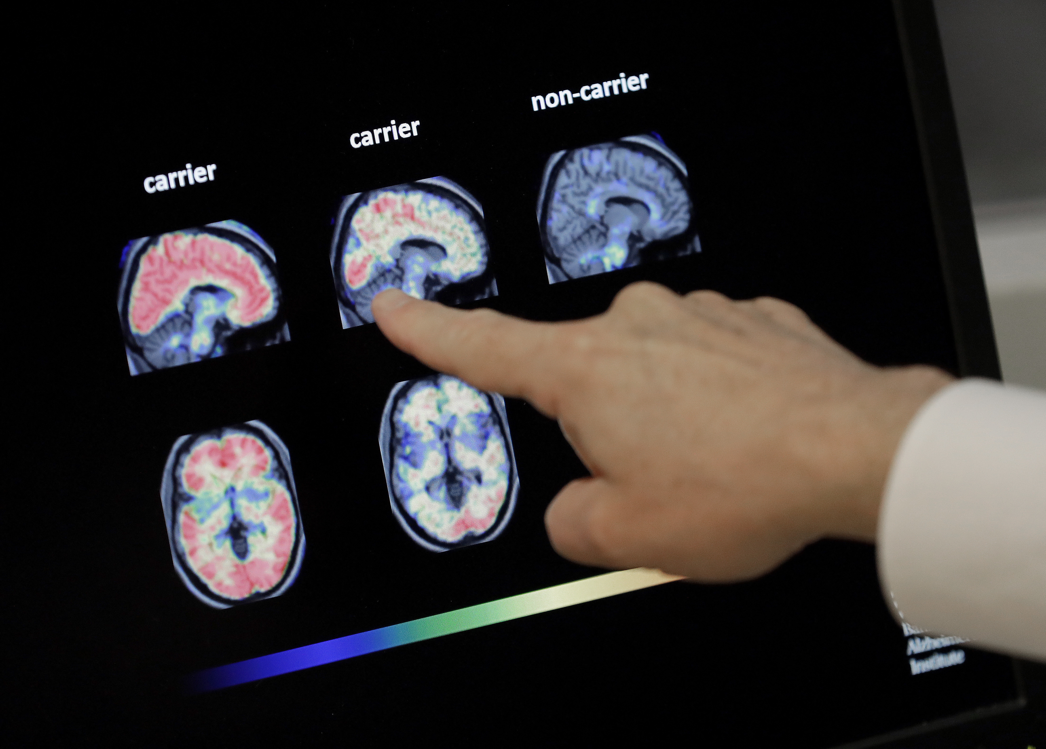 FILE - A doctor looks at PET brain scans at Banner Alzheimers Institute in Phoenix on Aug. 14, 2018. (AP Photo/Matt York, File)