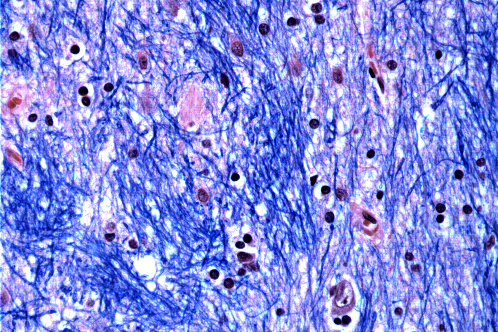 This microscope photo provided by the McLean Hospital's Harvard Brain Tissue Resource Center in January 2024 shows cells in the caudate nucleus structure of the brain in a person with Huntington's disease. (McLean Hospital's Harvard Brain Tissue Resource Center/NIH NeuroBioBank via AP)